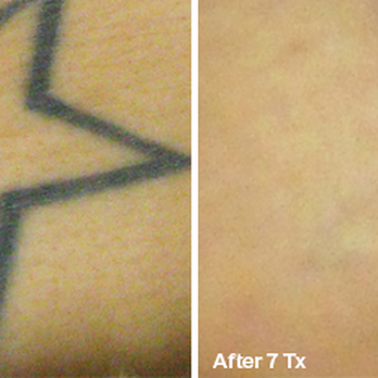 Nu Skyn - Tattoo Removal Near Me - Fort Wayne, Indiana Nu Skyn - Tattoo Removal Near Me - Fort Wayne, Indiana