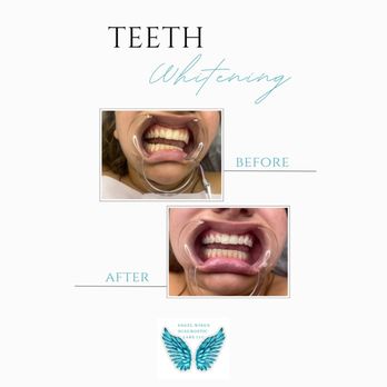 Angel Wings - Laboratory Testing Near Me - Plantation, Florida Angel Wings - Laboratory Testing Near Me - Plantation, Florida