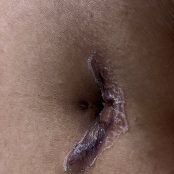Texas Laparoscopic Consultants - Gigantic umbilical Scar vs prior umbilical scar from prior unrelated surgery made to remove a MUCH BIGGER organ. - Weight Loss Centers Near Me - Houston, Texas Texas Laparoscopic Consultants - Gigantic umbilical Scar vs prior umbilical scar from prior unrelated surgery made to remove a MUCH BIGGER organ. - Weight Loss Centers Near Me - Houston, Texas