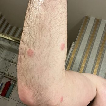 Quality Inn - Bed Bug bites I received during my stay at the Demming Quality Inn in Room 108 in March of 2024 - Hotels Near Me - Deming, New Mexico