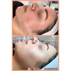 Starlight Med Spa - Starlight is known for "skin transformations"