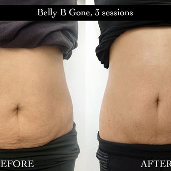 Beauty by Lati - Belly B Gone after 3 sessions - Eyelash Service Near Me - Austin, Texas Beauty by Lati - Belly B Gone after 3 sessions - Eyelash Service Near Me - Austin, Texas