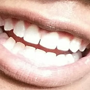 My Braces Doctor - After - Orthodontists Near Me - Alexandria, Virginia My Braces Doctor - After - Orthodontists Near Me - Alexandria, Virginia