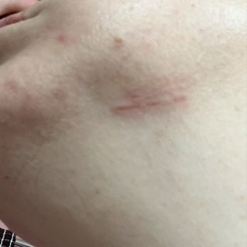 Farrah Beauty Center - Burn from the extraction tool. - Medical Spas Near Me - Sterling, Virginia