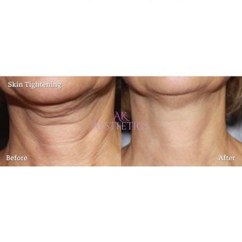 AK Aesthetics - Radio frequency skin tightening - Skin Care Near Me AK Aesthetics - Radio frequency skin tightening - Skin Care Near Me