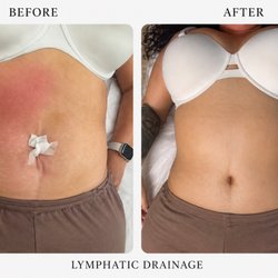 Anaheim Body Sculpting - Post op lymphatic drainage
