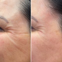 Excellence Medical Spa - Botox before and after