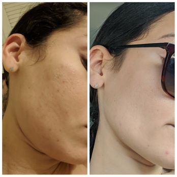 Healing Hands - Micronedling before and after 1 treatment - Massage Near Me - Bonita Springs, Florida Healing Hands - Micronedling before and after 1 treatment - Massage Near Me - Bonita Springs, Florida
