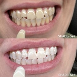 Teeth Whitening: before and after