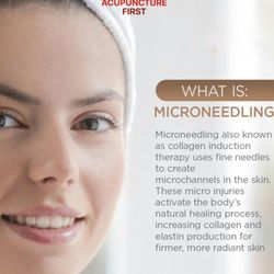 Acupuncture First - Meet one of our most loved skin therapies -- Microneedling, also known as collagen induction therapy.