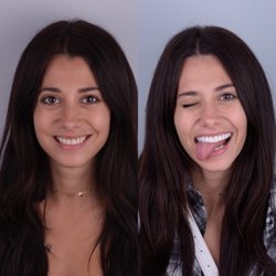 Nader Yermian, DDS - Vicente Dental - Fun makeover for this goofy patient. 10 porcelain veneers