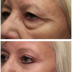 Aesthetic Eye Care - Before and after upper and lower lid blepharoplasty and endoscopic brow lift