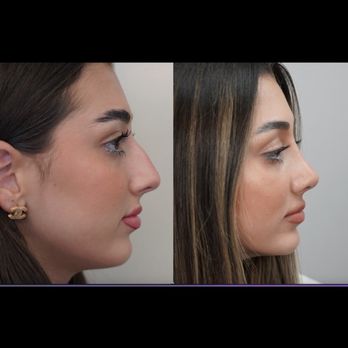 Vladimir Grigoryants, MD - Nose job - Cosmetic Surgeons Near Me - Glendale, California Vladimir Grigoryants, MD - Nose job - Cosmetic Surgeons Near Me - Glendale, California