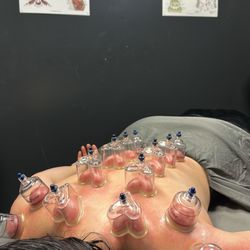 This is cupping therapy done after a deep tissue massage