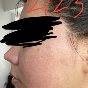 Skin By Char - 2/23/23 after a month of seeing Char skin irritation is almost completely gone - Acne Treatment Near Me - Westminster, California Skin By Char - 2/23/23 after a month of seeing Char skin irritation is almost completely gone - Acne Treatment Near Me - Westminster, California