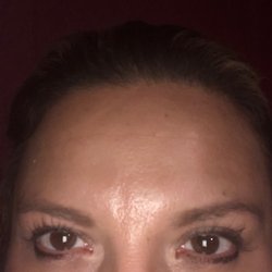 Arcadia Medical Spa - 3 weeks after