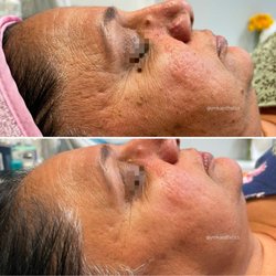 YMK Aesthetics - Customized Treatments (multiple sessions)