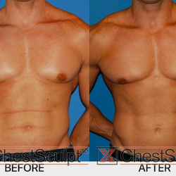 XSculpt - ChestSculpt™, minimally invasive treatment for Gynecomastia developed y Xsculpt™