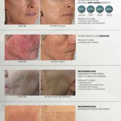 Rejuvenation with AnteAGE!