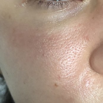 LaserAway - 3 weeks after my 4th treatment. My pores are still same and a color difference occurred between my under eye and the treated area - Laser Hair Removal Near Me - San Jose, California