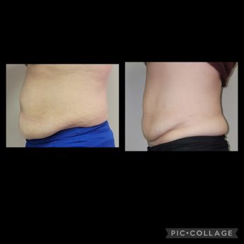 Body Secrets - 6 sessions complete - Body Contouring Near Me - Lockport, New York