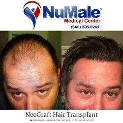 NuMale Medical Center - Platelet Rich Plasma (PRP) Hair Restoration Therapy for Men.