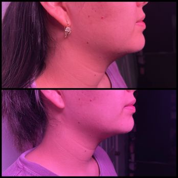 Infiniteglowspa - Double chin reduction - Skin Care Near Me - Mesquite , Texas Infiniteglowspa - Double chin reduction - Skin Care Near Me - Mesquite , Texas