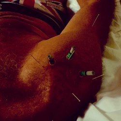 Christine Walinch, LAc - Shoulder strain treatment with acupuncture and moxa heat. This helps range of motion gains, tendon repair and loosens tight muscles. Win win