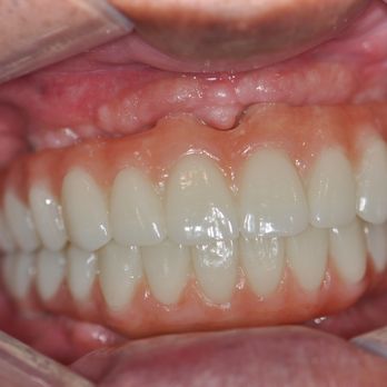 Renew Dental - Upper and lower fixed implant bridge placed and restored by Dr. Lawson, DDS BSC., Diplomate American Board of Implant Dentistry - Cosmetic Dentists Near Me - Calgary, Alberta Renew Dental - Upper and lower fixed implant bridge placed and restored by Dr. Lawson, DDS BSC., Diplomate American Board of Implant Dentistry - Cosmetic Dentists Near Me - Calgary, Alberta