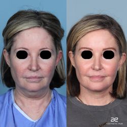 Luis Macias, MD, FACS - 5mo. post-op, Composite Extended Deep Plan Facelift with fat grafting to the mid face, pre-jowl sulcus, temples and lips.