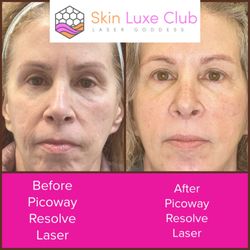 Laser Goddess - Laser Skin Rejuvenation.