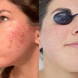 Cielo Skin Wellness - Acne Clearing Program