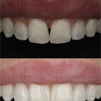 SmileStyle Dental Studio - Before and after Invisalign and cosmetic bonding - General Dentistry Near Me - San Diego, California SmileStyle Dental Studio - Before and after Invisalign and cosmetic bonding - General Dentistry Near Me - San Diego, California