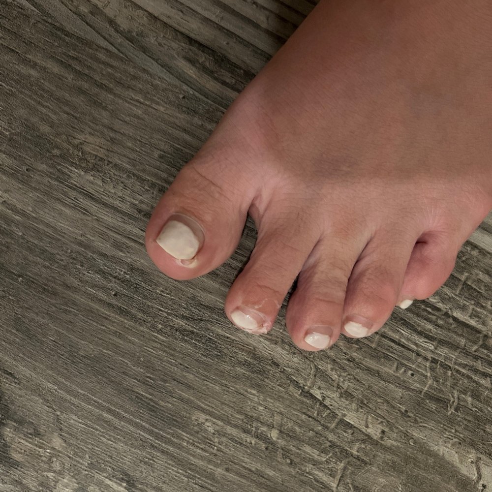 Big toe and second toe are ingrown nails three and four. Big toe and second toe are ingrown nails three and four.