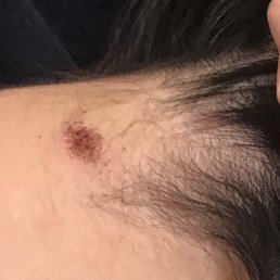 The scar on my neck due to the improper handling of perm chemicals by a student at the Paul Mitchell's school.