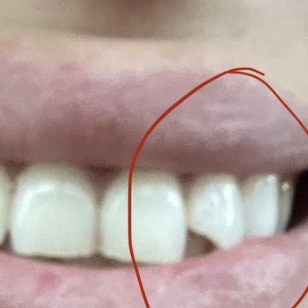 Special Smiles - Ps. See pic! That's the chipped tooth that will transition me to baby food? - Cosmetic Dentists Near Me - Imperial Beach, California