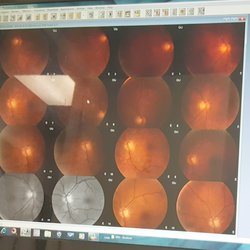 Triso M. Lara, MD - Not pictures of Mars, but of the retina area of my right eye