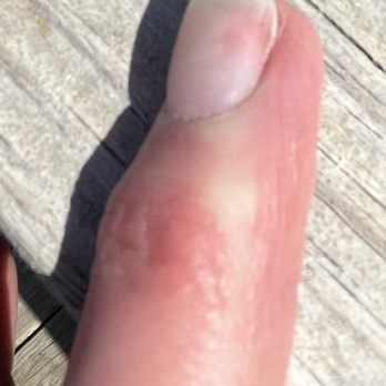 Alux Spa - Damaged nail bed, old acrylic. - Nail Salons Near Me - Brighton, Michigan