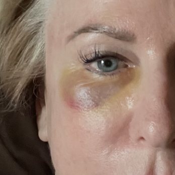 Artemedica - 6/10/21, after Dr Lacombe treated my tear trough with laser to break up the pooled blood. - Medical Spas Near Me - Santa Rosa, California Artemedica - 6/10/21, after Dr Lacombe treated my tear trough with laser to break up the pooled blood. - Medical Spas Near Me - Santa Rosa, California