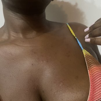 Risbo - Hives on chest. Allergic reaction to The Healthy One that has always been nut-free - French Near Me - Brooklyn, New York Risbo - Hives on chest. Allergic reaction to The Healthy One that has always been nut-free - French Near Me - Brooklyn, New York