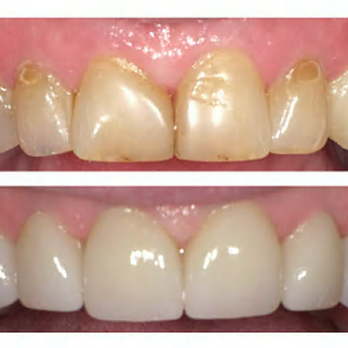Leslie P Dillard, DDS - Porcelain crowns - General Dentistry Near Me - Nashville, Tennessee Leslie P Dillard, DDS - Porcelain crowns - General Dentistry Near Me - Nashville, Tennessee