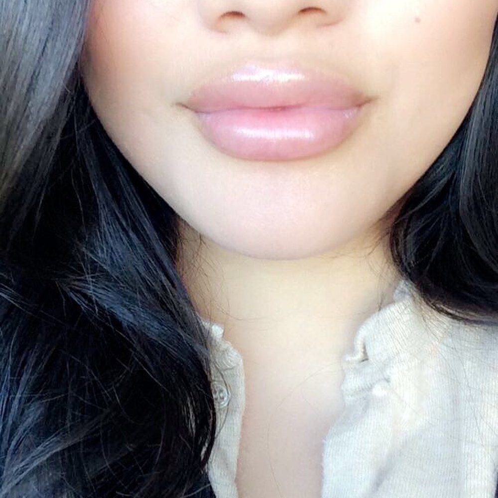 Juvederm Lip Injections Juvederm Lip Injections