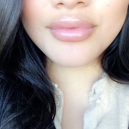 Juvederm Lip Injections