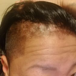 Hair+Co - Burn marks and you fucked up my hairline!