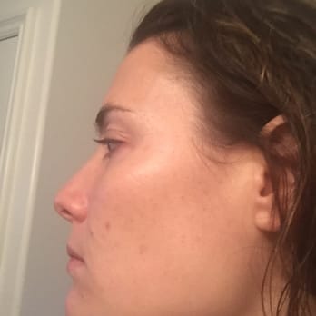 Cure - After a week skin is much clearer. - Medical Spas Near Me - Malibu, California