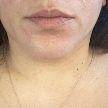 The Glow Method Skin Bar - Before - Skin Care Near Me - Surprise, Arizona