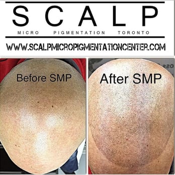 Scalp Micropigmentation Center - SMP Training Canada - Hair Loss Centers Near Me - Toronto, Ontario