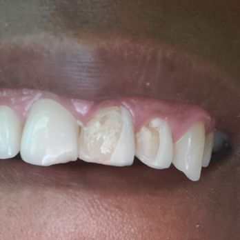 Flamingo Smiles Dentistry - My BEFORE photo - General Dentistry Near Me - Las Vegas, Nevada Flamingo Smiles Dentistry - My BEFORE photo - General Dentistry Near Me - Las Vegas, Nevada