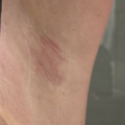 Rose Laser and Skin Care - Wax irritation and pain lasting several days due to poor technique and product.