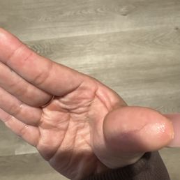 My cuts that happen when I opened the aluminum containers